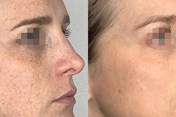 قبل و بعد درمان لکه های قهوه ای پوست با لیزر ای پی ال