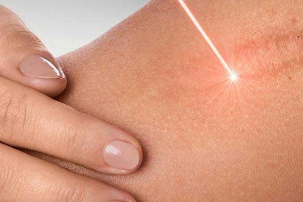 لیزر‌تراپی؛ ترمیم کننده قوی جای زخم