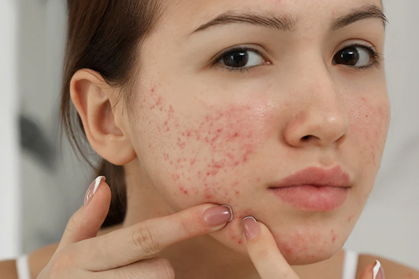 عوارض جوش های کیستیک صورت