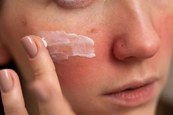 تاثیر کرم روی بروز میلیا